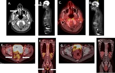 Neoadjuvant ipilimumab plus nivolumab therapy as a potential organ preservation strategy in mucosal melanoma: case report